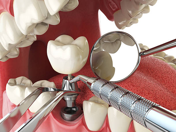 Best Knocked-Out Tooth (Avulsed Tooth) Treatment in Lake Mills, IA